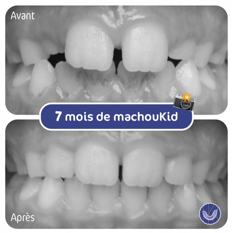 MachouKid Gouttière dentaire pour enfant - Positionnement des dents